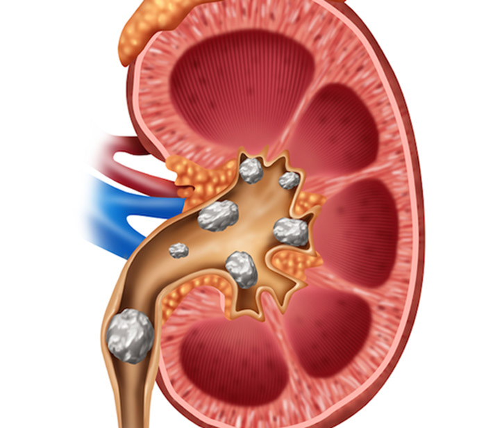 Kidney Stone Specialist in Jammu