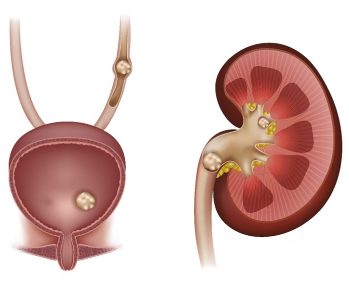 Kidney Stone Specialist In Pathankot